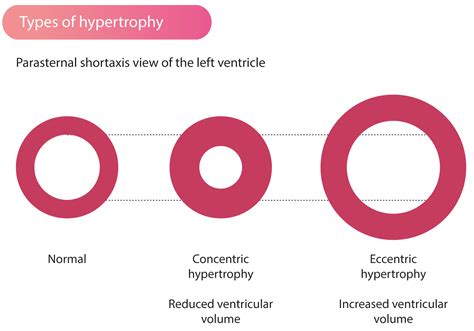 concentric hypertrophy